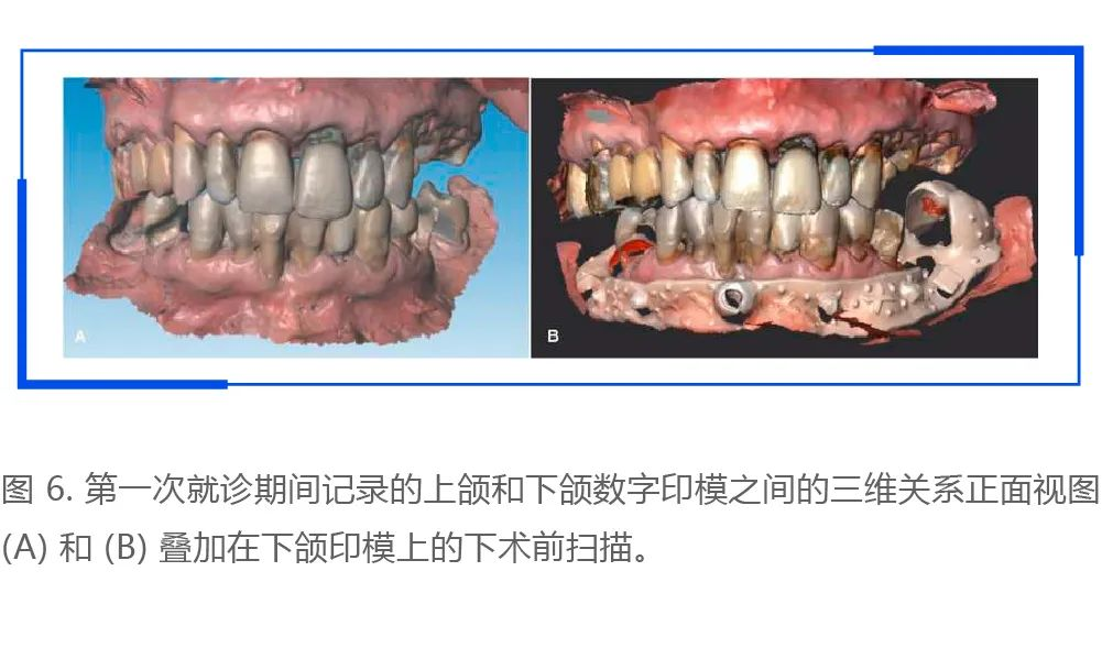利用口腔掃描儀進行術(shù)前口內(nèi)掃描和數(shù)字化設計