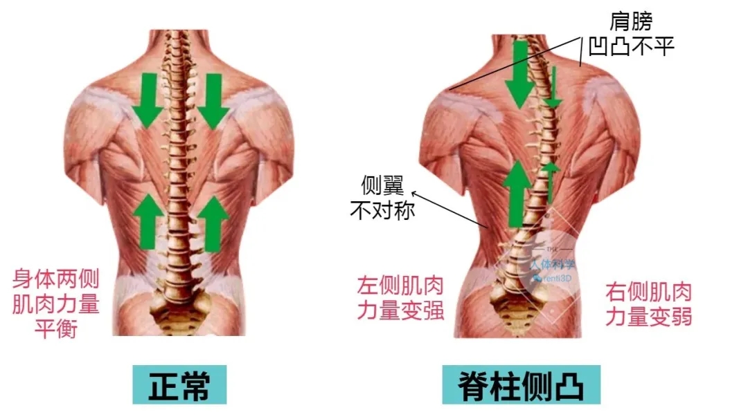 3D打印脊柱側(cè)彎矯形器：從“被動矯正”到“精準(zhǔn)醫(yī)療”的跨越式革新  